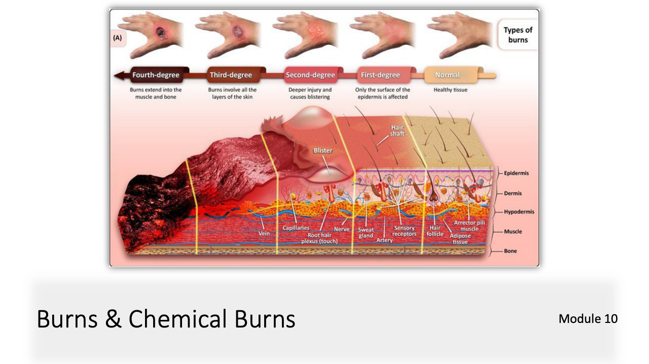 Module 10: Burns & Chemical Burns